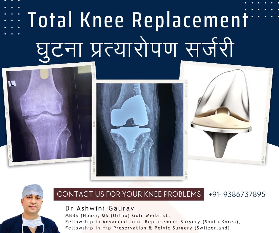 Dr. Ashwini Gaurav | Ortho Patna | Best Orthopedic Doctor in Patna | Arthritis Doctor & Best Joint Replacement Surgeon Patna - Sampatchak - Psychomotricity