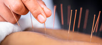 Raquel Perestrelo - Moita - Acupuncture Services