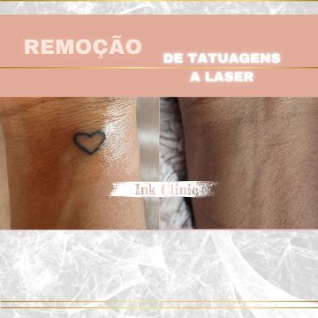 Ink Clinic Ericeira - Mafra - Drenagem Linfática