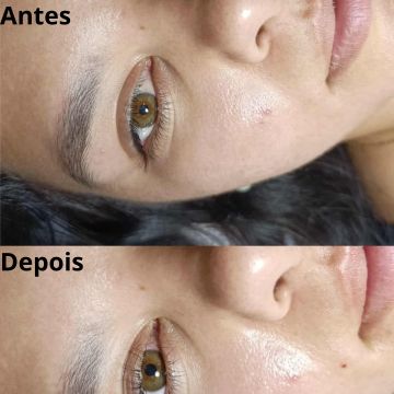 laserlashes_by_telma - Seixal - Depilação