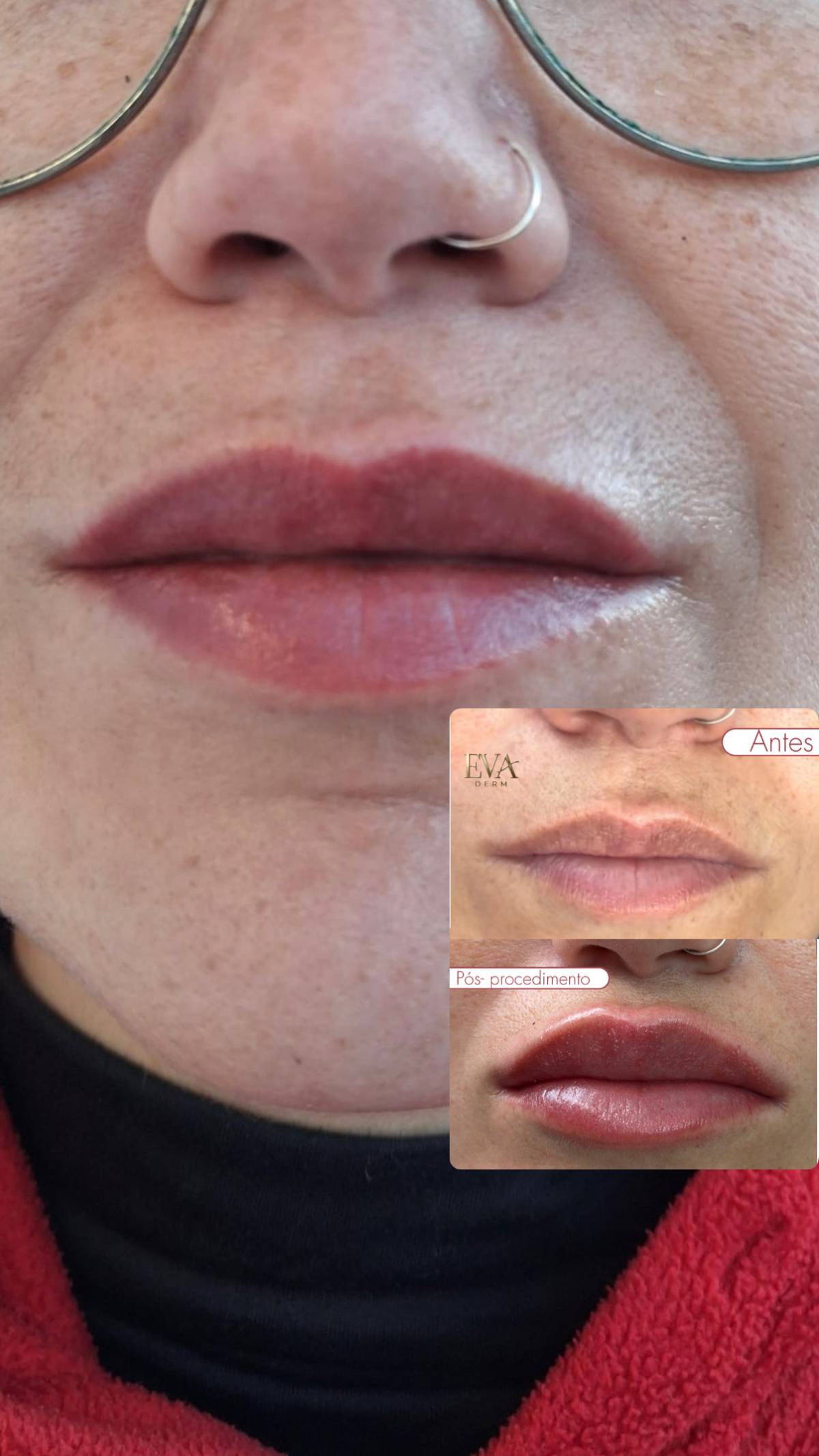 Eva Derm | Micropigmentação Labial & Laser - Figueira da Foz - Mikropigmentierung