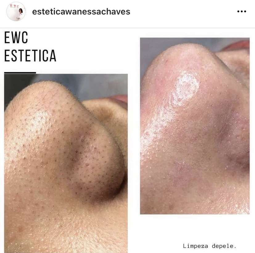 Estética Wanessa Chaves - Loures - Skin Cleansing
