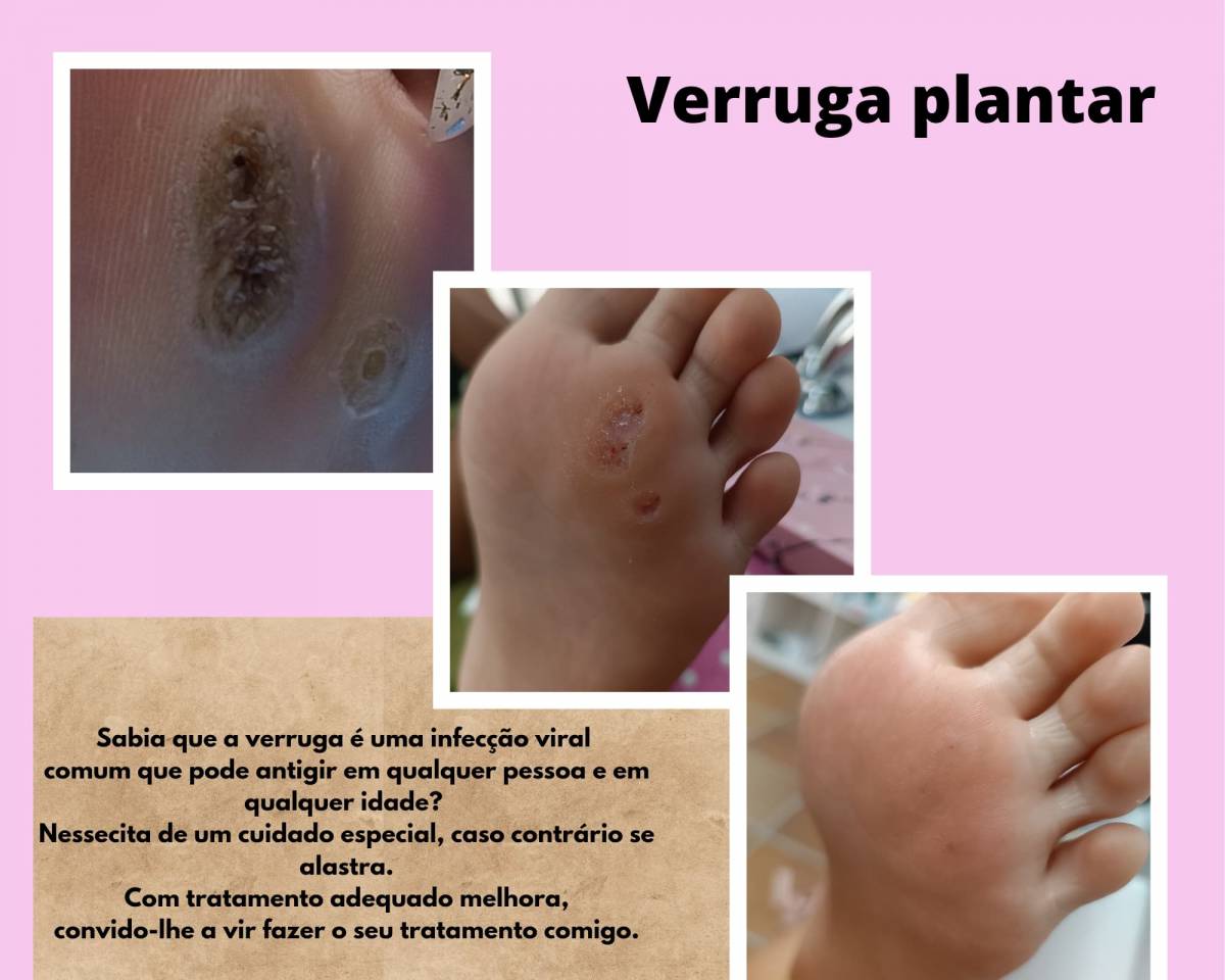 Lindastylesnails - Sesimbra - Laser Depilation