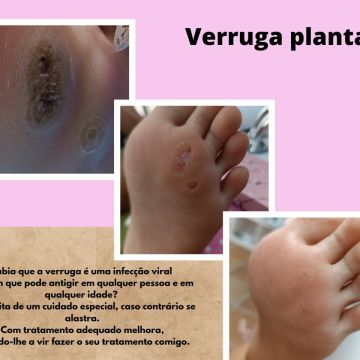 Lindastylesnails - Sesimbra - Laser Depilation