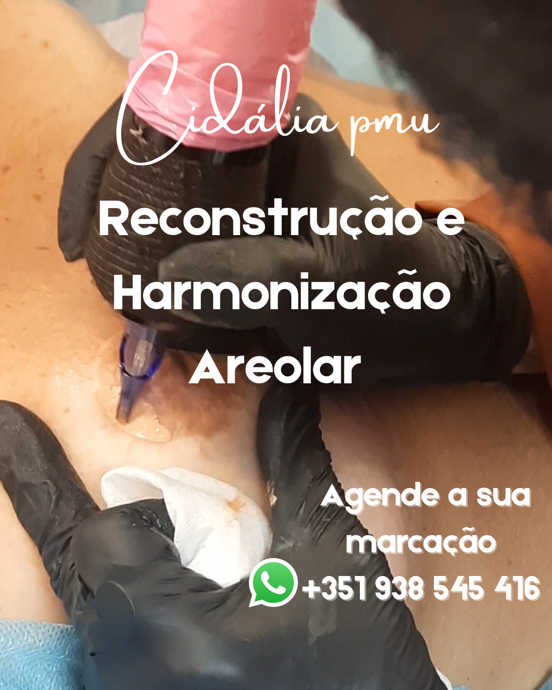 Cidália pmu - Seixal - Depilação a Laser