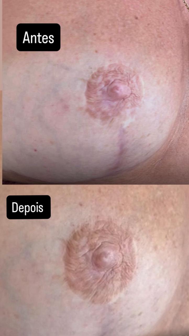 Cidália pmu - Seixal - Depilação a Laser