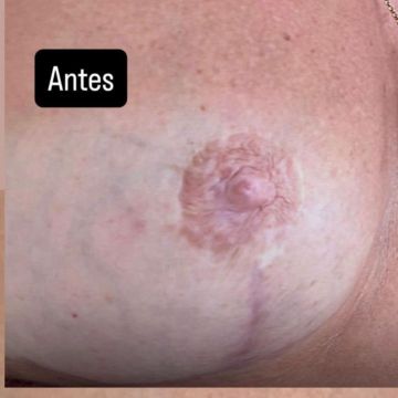 Cidália pmu - Seixal - Depilação a Laser