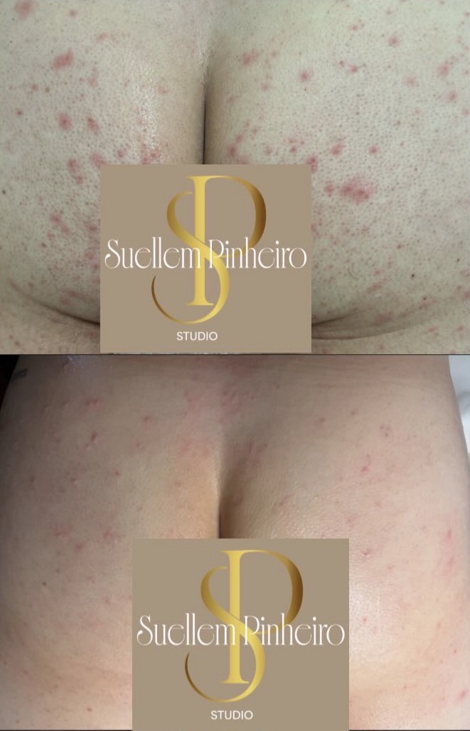 Suellem Pinheiro Studio - Santa Maria da Feira - Skin Cleansing