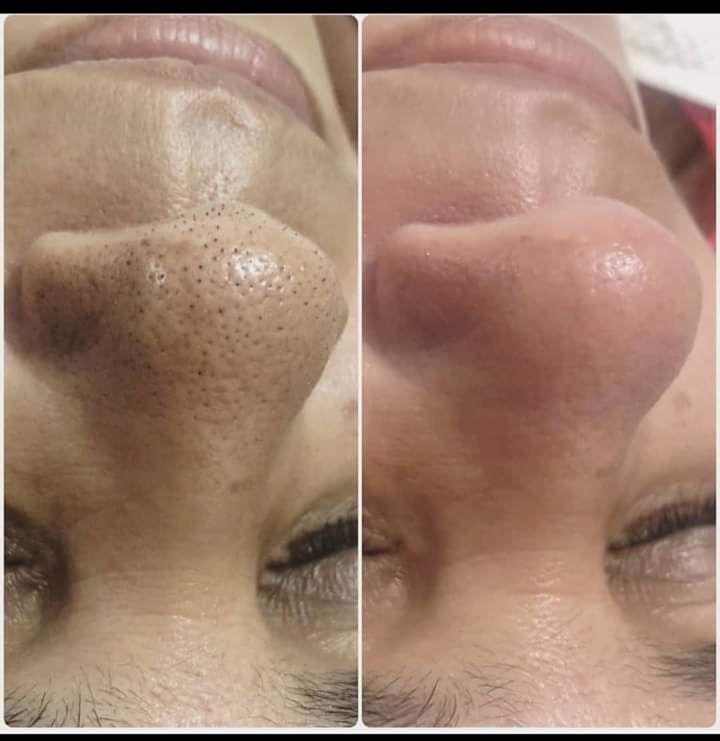 Massoterapia e Estética - Maia - Skin Cleansing