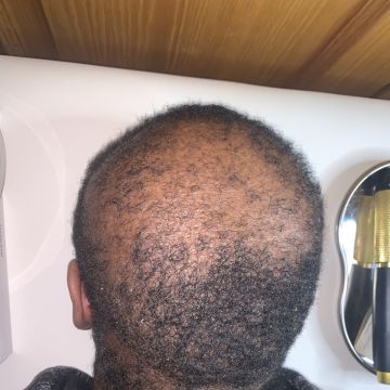 Débora Vicêncio - Almada - Hair Removal for Men
